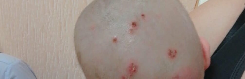 В Одесі з наркопритону врятували півторарічну дитину з ранами від вошей