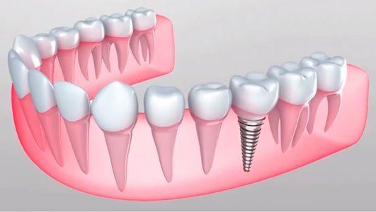 Імплантація, фото-2 Імплантація, фото-2