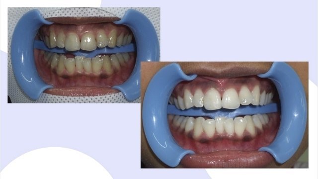 Відбілювання, фото-2 Відбілювання, фото-2