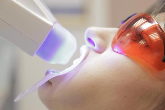 Відбілювання, фото-1 Відбілювання, фото-1