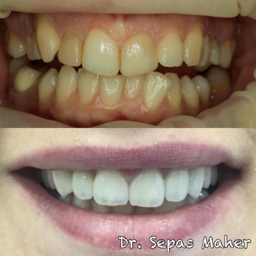 Вініри, фото-1 Вініри, фото-1