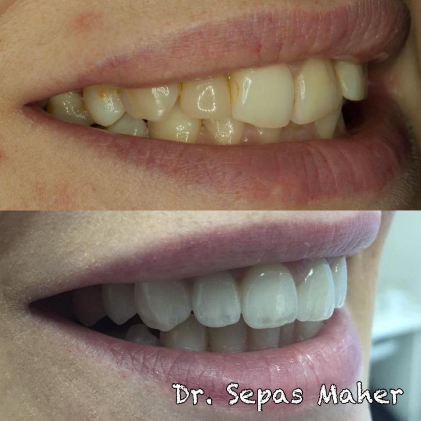 Вініри, фото-2 Вініри, фото-2