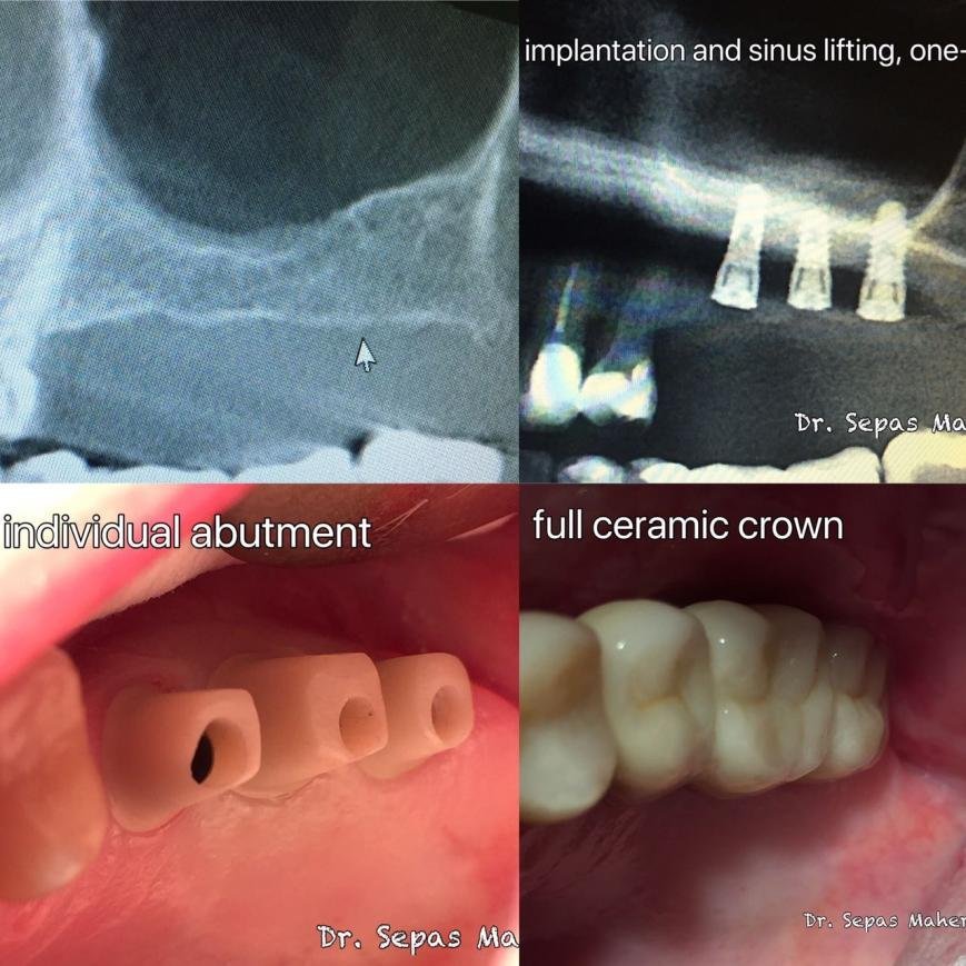 Сінус Ліфтинг та пересадка кістки, фото-2 Сінус Ліфтинг та пересадка кістки, фото-2