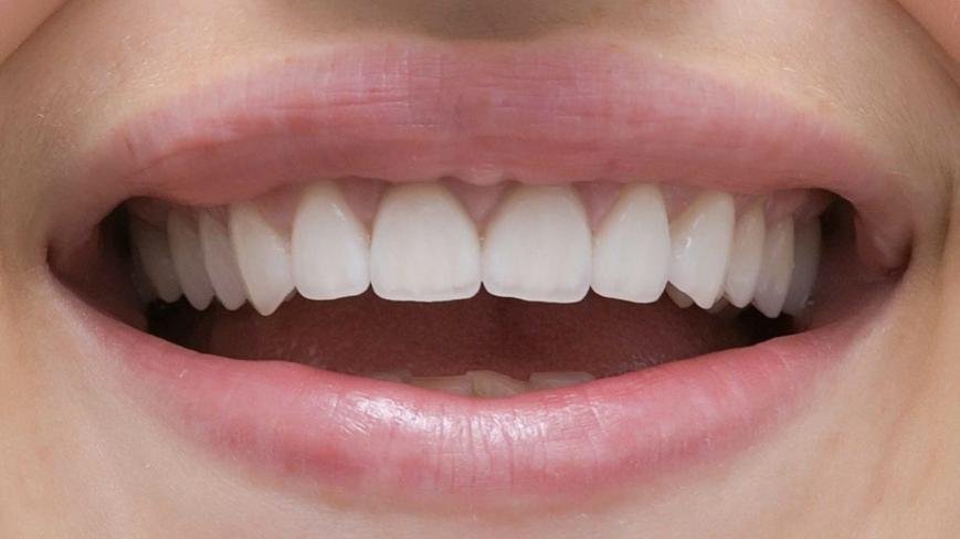 Вініри, фото-3 Вініри, фото-3