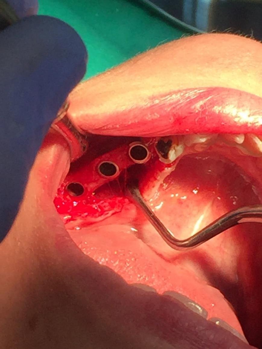 Сінус Ліфтинг та пересадка кістки, фото-3 Сінус Ліфтинг та пересадка кістки, фото-3