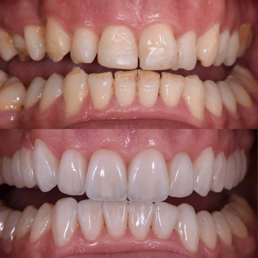 Вініри, фото-4 Вініри, фото-4