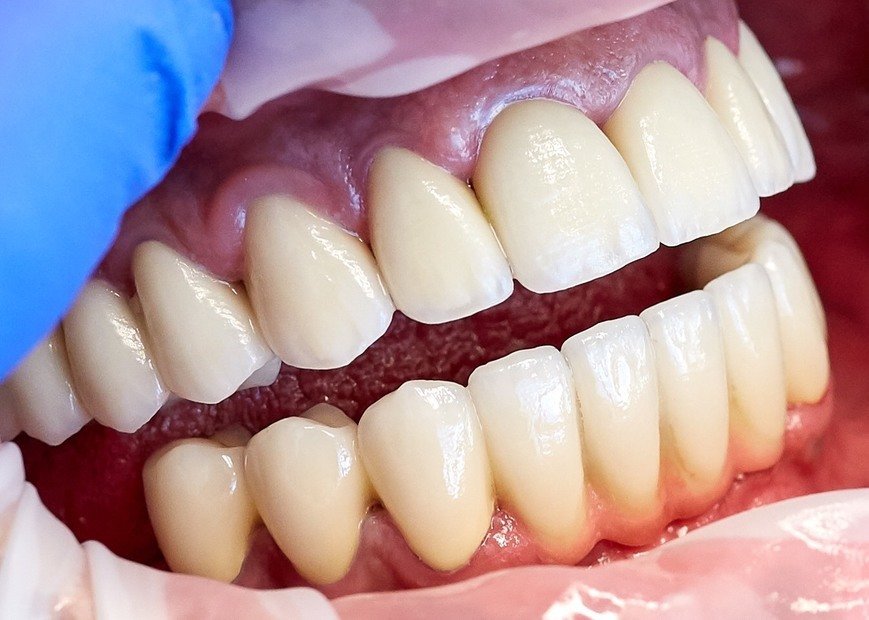 Металокерамічні коронки, фото-3 Металокерамічні коронки, фото-3