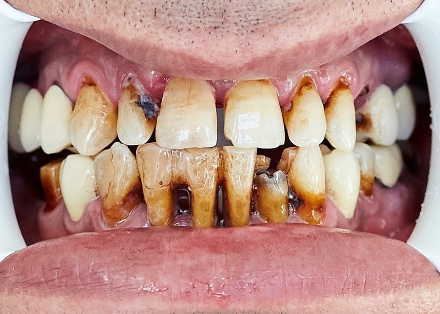 Металокерамічні коронки, фото-1 Металокерамічні коронки, фото-1