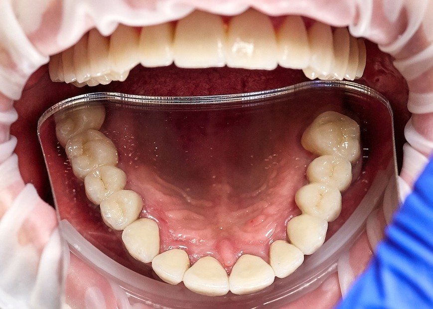 Металокерамічні коронки, фото-2 Металокерамічні коронки, фото-2