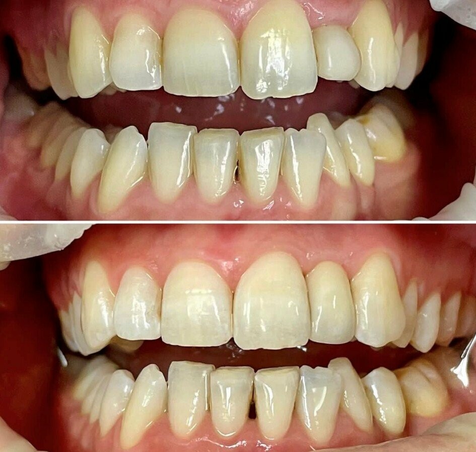 Відновлення зубів керамічними коронками, фото-4