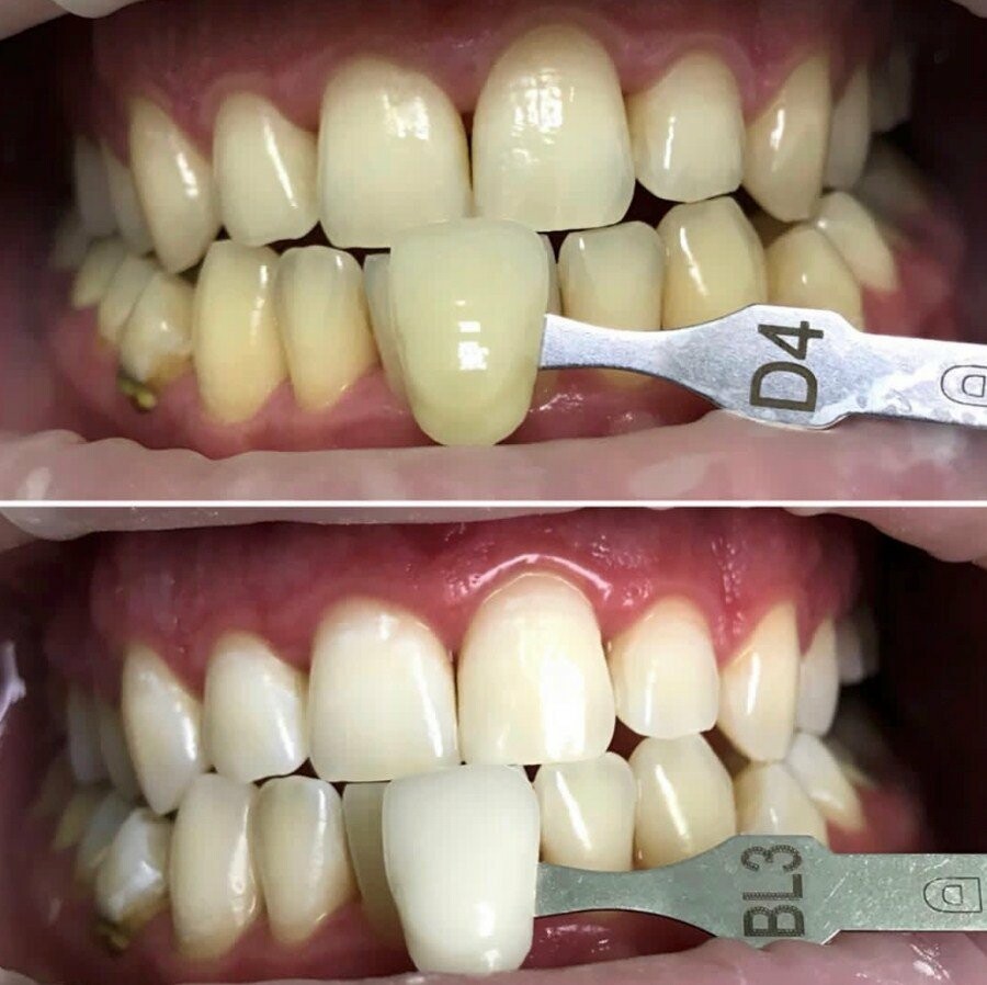Відбілювання зубів, фото-2