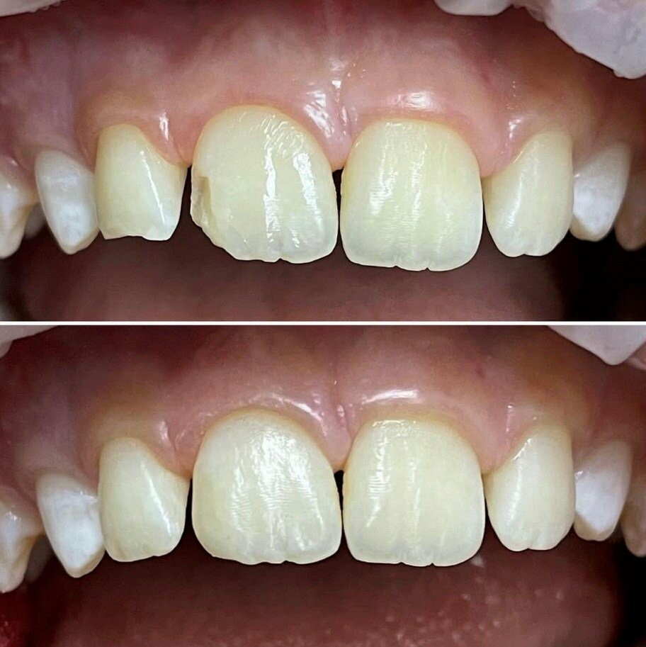 Реставрація та лікування передніх зубів, фото-1