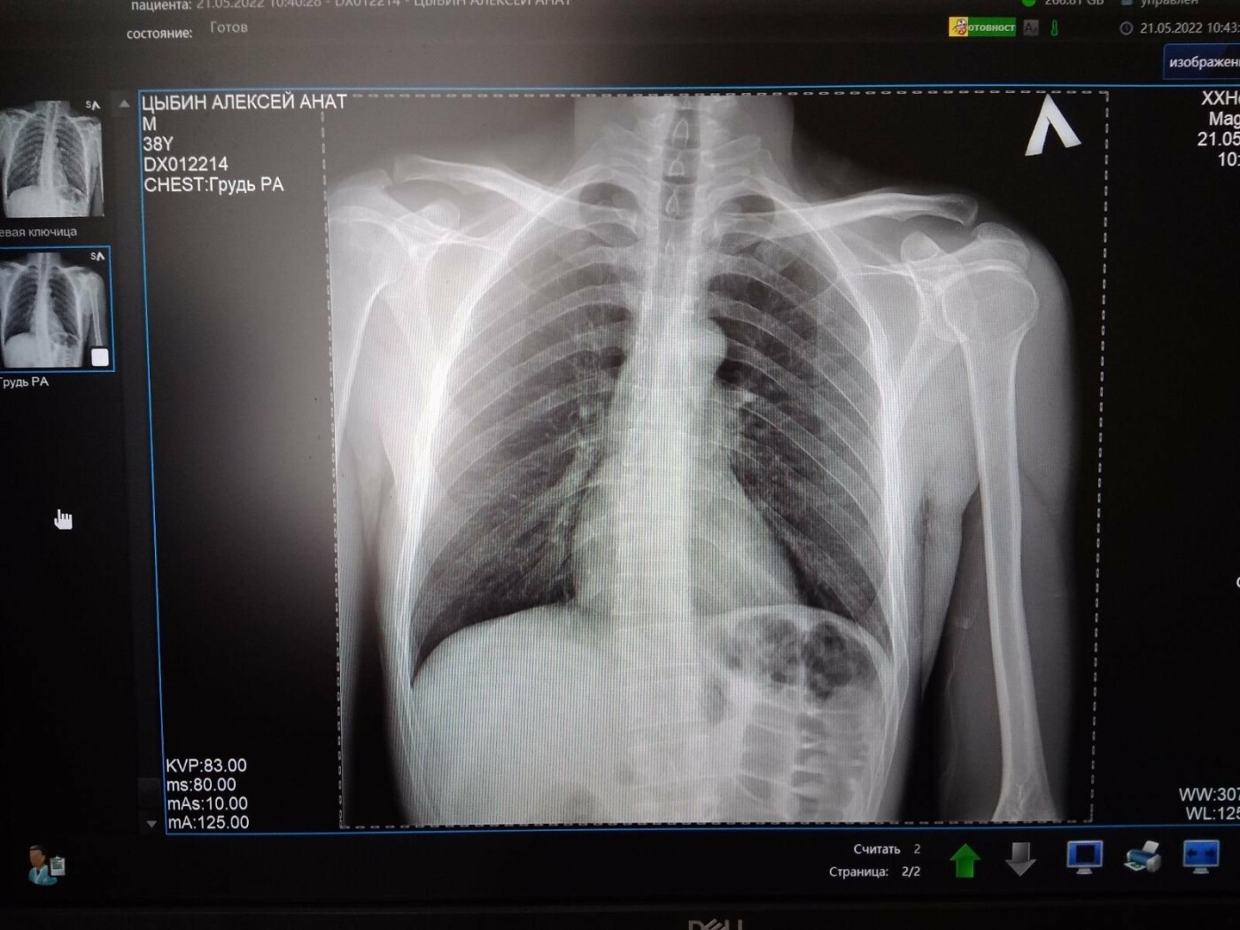Намагався звинуватити постраждалого: в Одесі через необачного водія сильно травмувався велосипедист, - ФОТО , фото-2